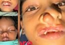 चिरायु योजना से जन्मजात समस्या से मिली राहत, तीन बच्चों के चेहरों पर लौटी मुस्कान